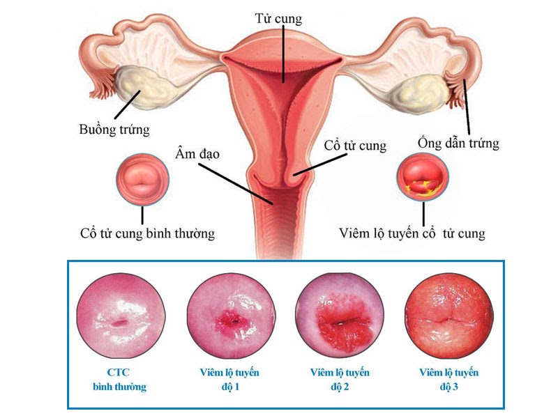 Mỗi cấp độ bệnh sẽ có các triệu chứng khác nhau