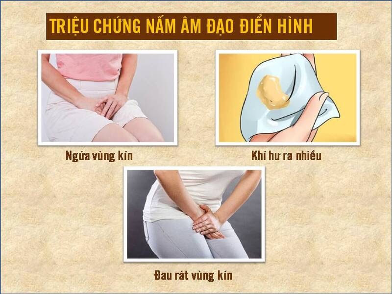 Triệu chứng nấm âm đạo điển hình