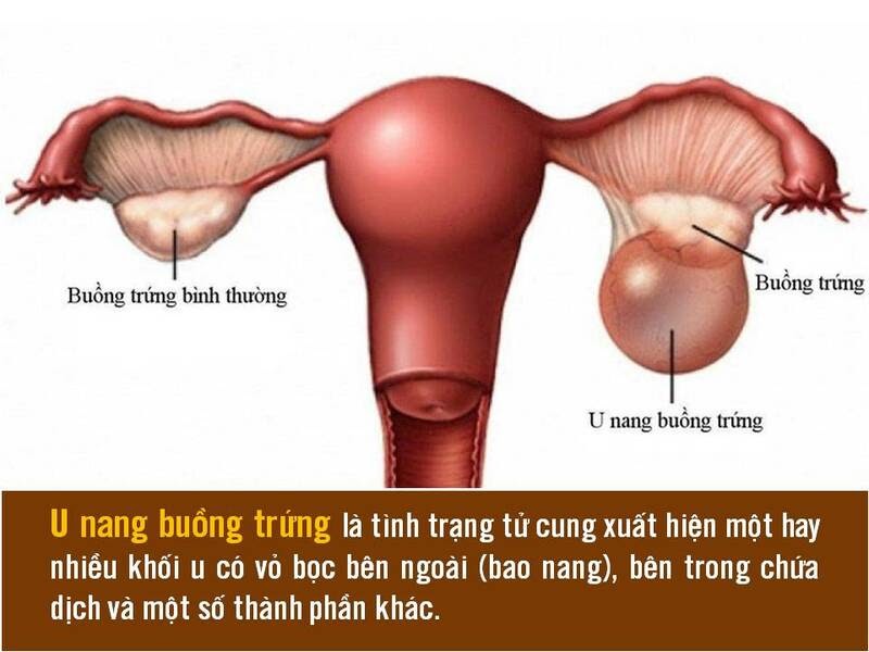 U nang buồng trứng là tình trạng tử cung xuất hiện nhiều khối u bên ngoài