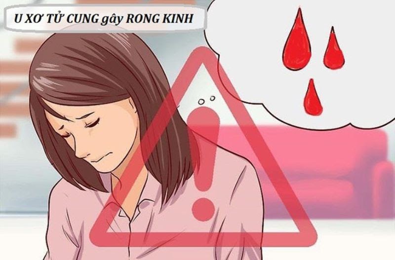 U xơ tử cung có thể gây rong kinh