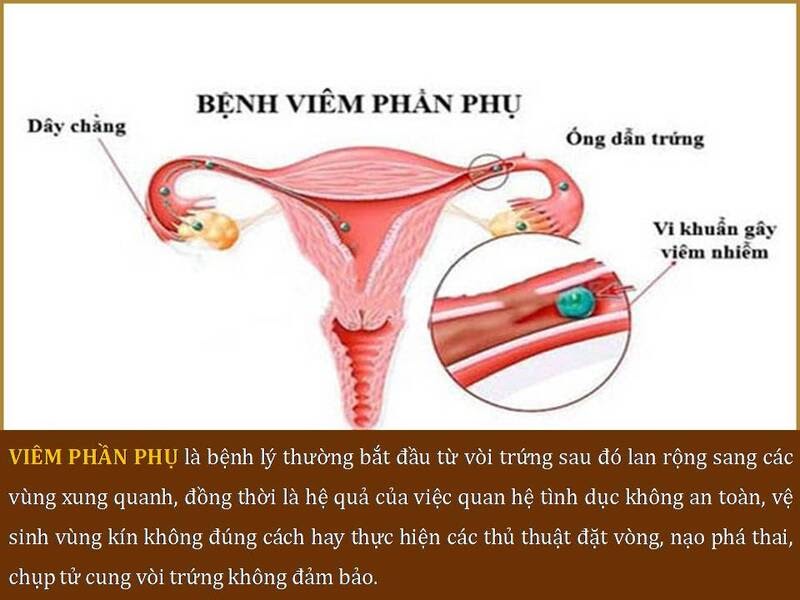 Viêm phần phụ là tình trạng viêm nhiễm thường gặp