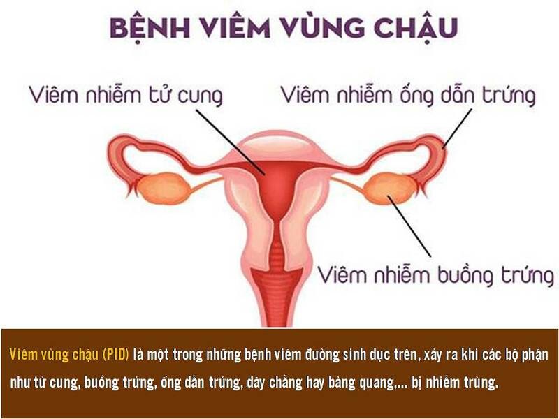 Viêm phần phụ là tình trạng bệnh viêm nhiễm thường gặp