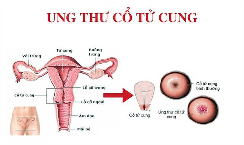 Ung thư cổ tử cung là căn bệnh nguy hiểm với chị em 