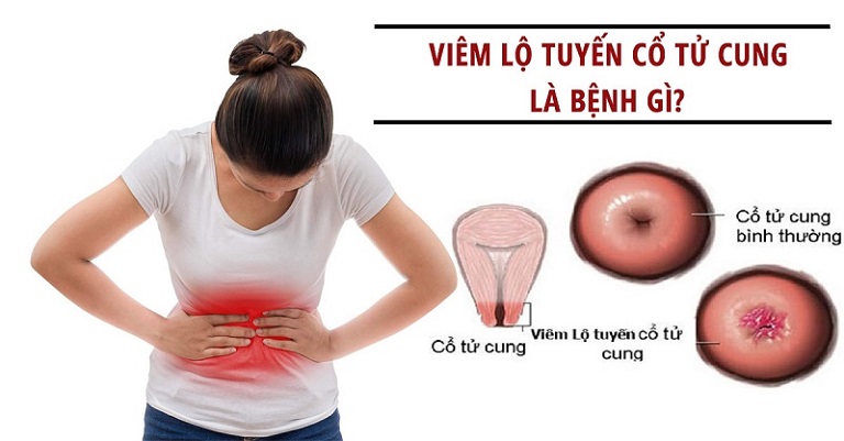 Viêm lộ tuyến cổ tử cung là gì? 