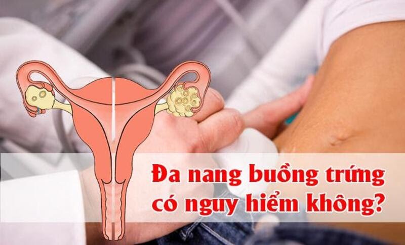 Buồng trứng đa nang có nguy hiểm không là thắc mắc của nhiều bệnh nhân