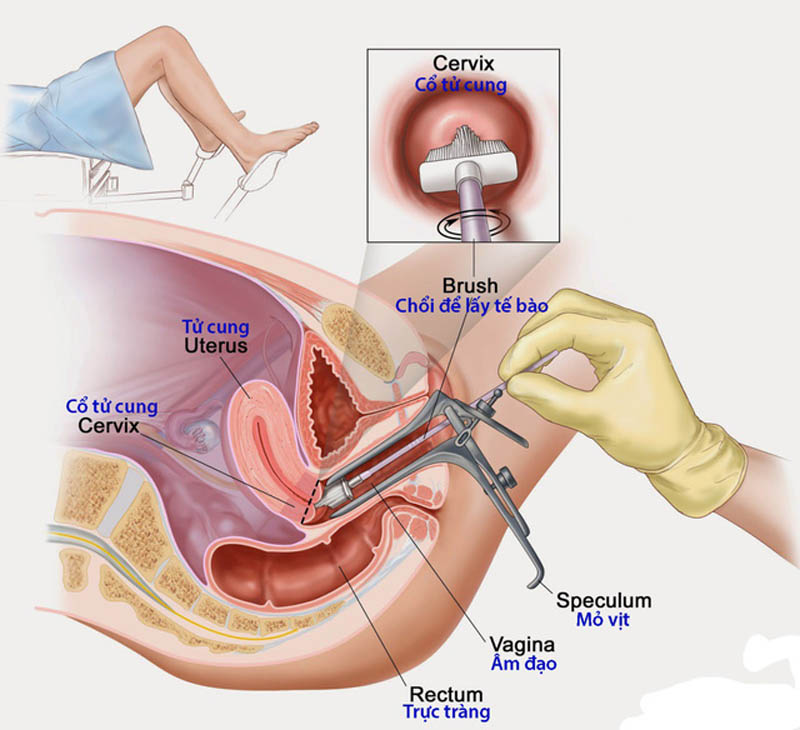 Chữa ung thư tử cung bằng phương pháp phẫu thuật