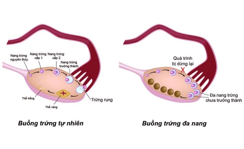 Hình ảnh buồng trứng đa nang 