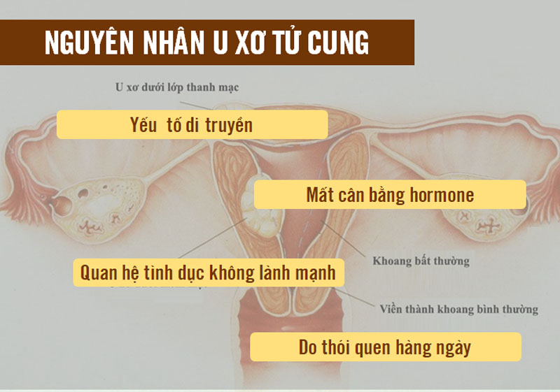 Nguyên nhân u xơ tử cung