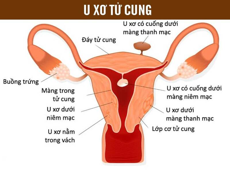 U xơ tử cung là tình trạng khá phổ biến ở nữ giới