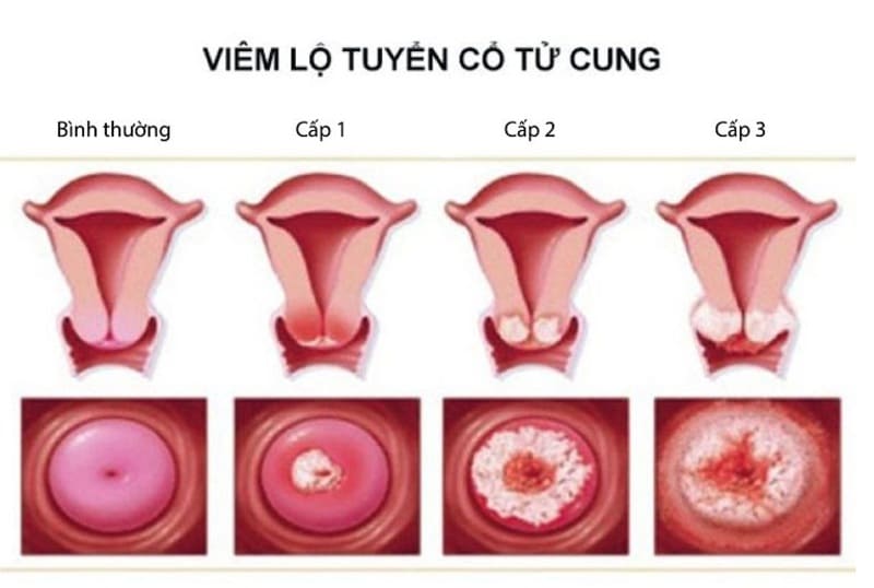 Bà bầu bị viêm lộ tuyến cổ tử cung có nguy hiểm không?