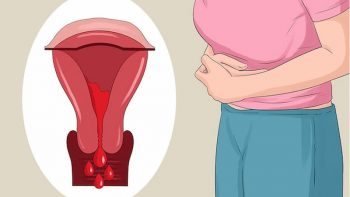 Lạc nội mạc tử cung là gì? Phải làm sao để điều trị tận gốc?