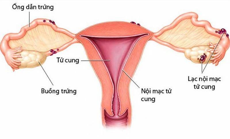Lạc nội mạc tử cung xảy ra khi các mô nội mạc tử cung phát triển sai vị trí