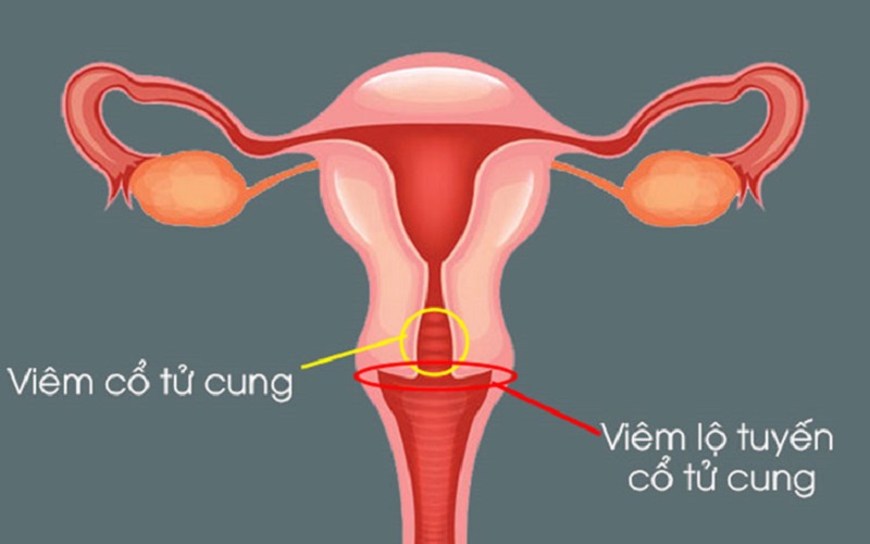 Bệnh được phân chia thành hai giai đoạn cấp và mãn tính