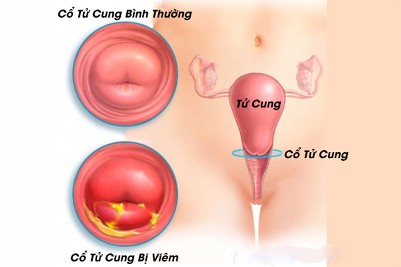 Hình ảnh viêm cổ tử cung thường gặp