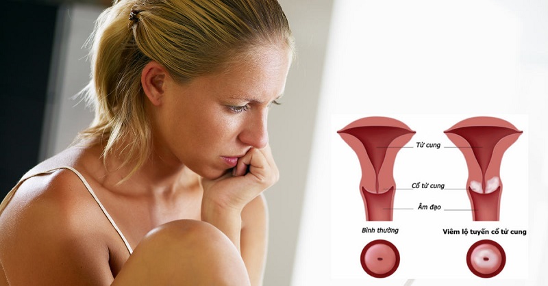 Có nhiều nguyên nhân gây bệnh viêm cổ tử cung ở nữ giới