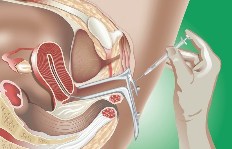 Giải đáp chính xác thắc mắc: “Viêm lộ tuyến có làm IUI được không?”