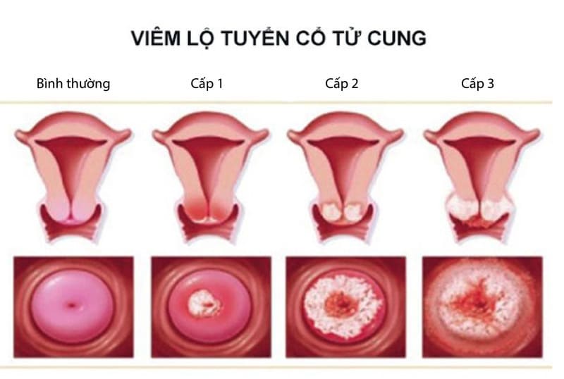 Viêm lộ tuyến có nên đốt không còn phụ thuộc vào đối tượng và cấp độ viêm nhiễm