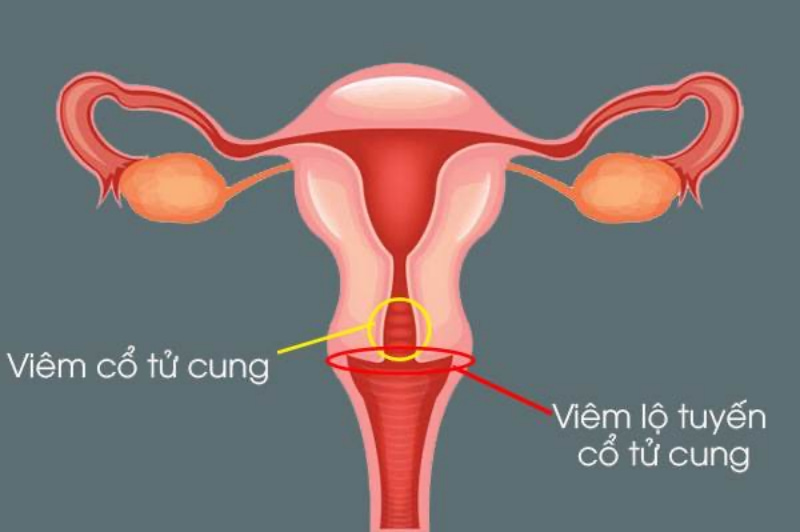 Viêm lộ tuyến cổ tử cung độ 4 chính là giai đoạn 3 của bệnh với biểu hiện nặng nhất