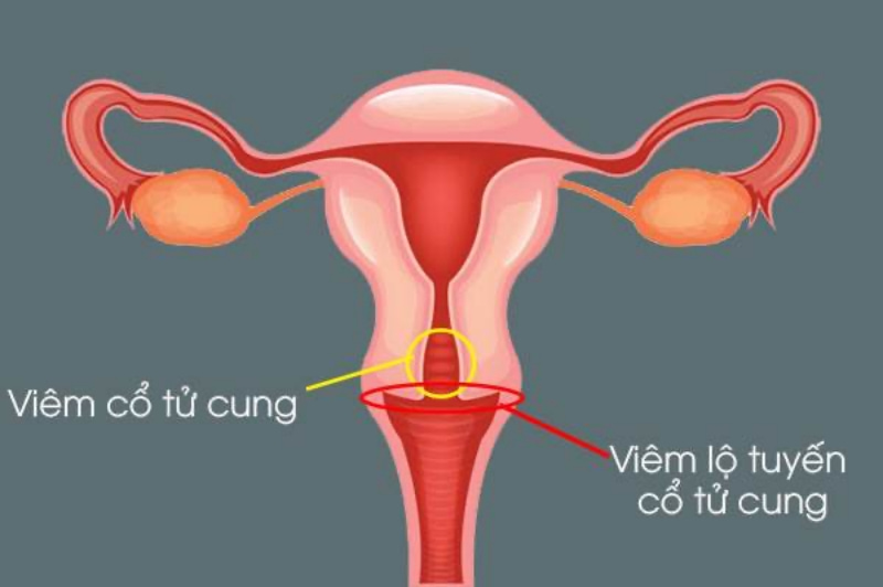 Viêm lộ tuyến cổ tử cung độ 4 chính là giai đoạn 3 của bệnh với biểu hiện nặng nhất