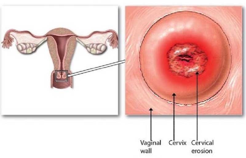 Viêm lộ tuyến dạng sùi là bệnh lý xuất hiện càng nhiều hiện nay