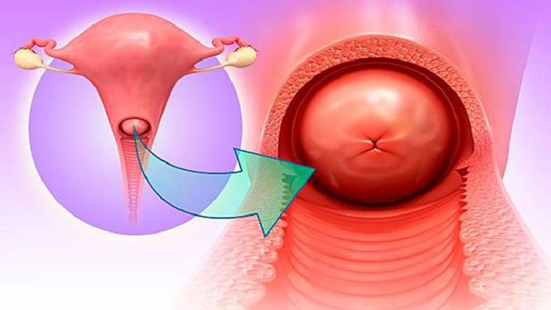 Giải đáp chính xác: Viêm lộ tuyến độ 1 là bệnh gì và hướng giải quyết chính xác