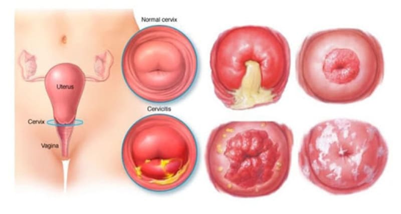 Hình ảnh viêm lộ tuyến độ 2