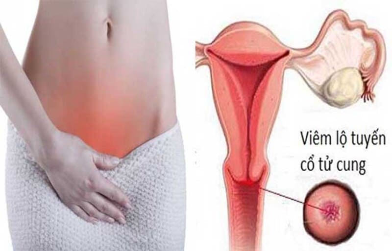 Khi bị viêm nhiễm, người bệnh sẽ có một số triệu chứng ngứa, đau rát