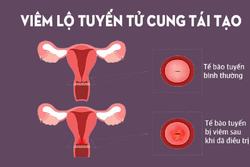 Giải đáp chính xác: “Viêm lộ tuyến tái tạo cổ tử cung là gì và cách chữa”