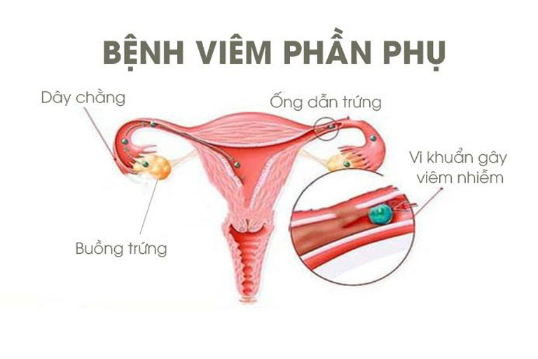 Viêm phần phụ ảnh hưởng tới khả năng mang thai của chị em