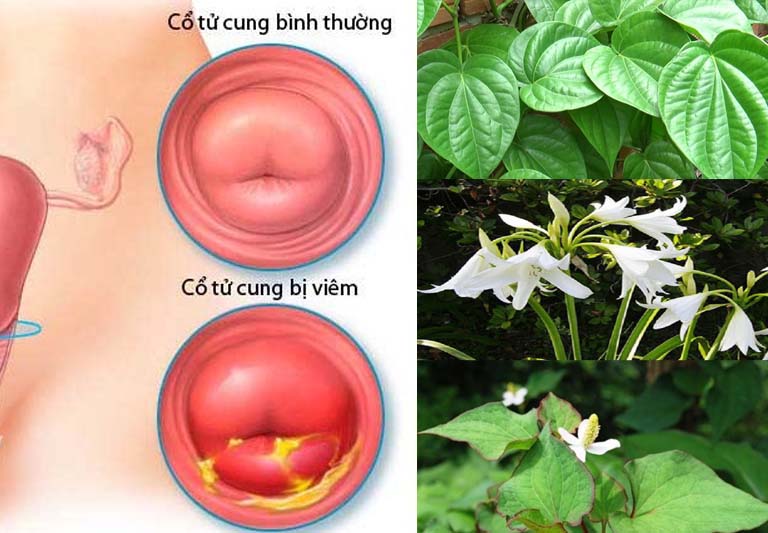 10 Cách xử lý viêm cổ tử cung tại nhà bằng phương pháp dân gian lành tính