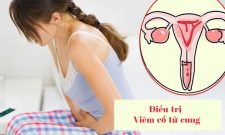 Các phương pháp điều trị viêm cổ tử cung hiệu quả không phải ai cũng biết