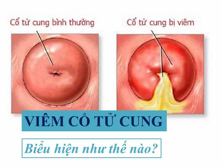 Viêm cổ tử cung là triệu chứng viêm nhiễm tổn thương ở vùng nối giữa âm đạo và tử cung