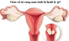 Viêm Cổ Tử Cung Mãn Tính Là Tình Trạng Gì? Điều Trị Như Thế Nào An Toàn, Triệt Để?