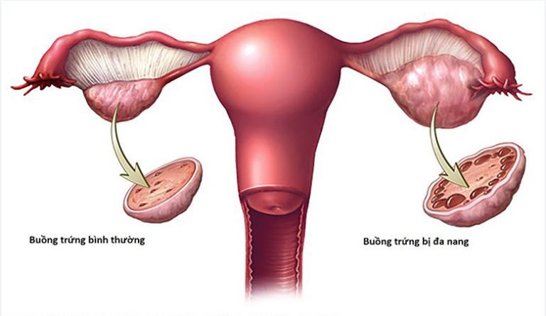 Hình ảnh buồng trứng đa nang và buồng trứng thường