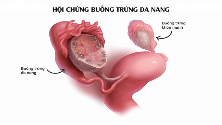 Chọn thuốc buồng trứng đa nang cần phù hợp với thể bệnh