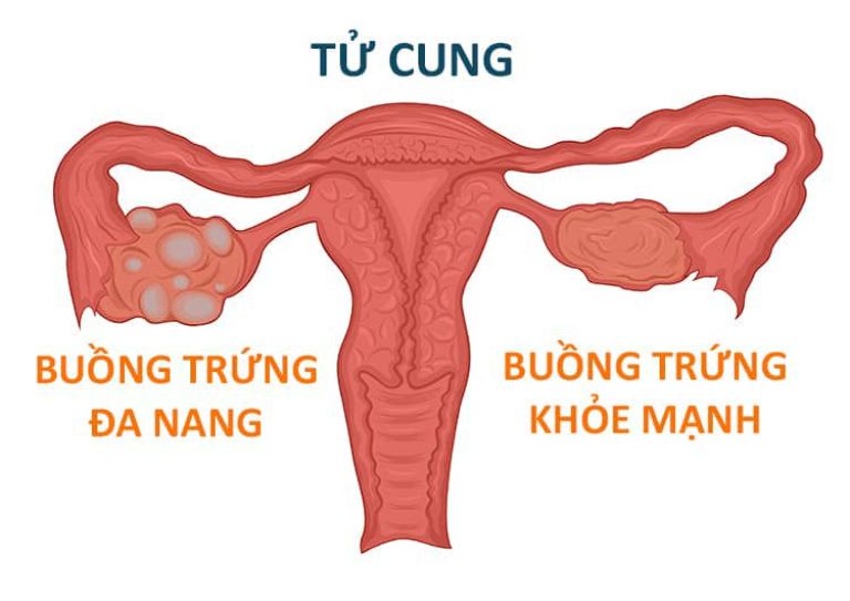 Hình ảnh đa nang buồng trứng ở nữ giới