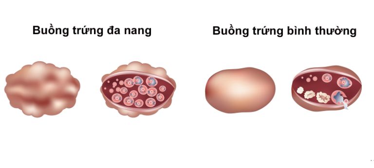 Điều trị buồng trứng đa nang bằng thuốc kích trứng để tăng khả năng mang thai