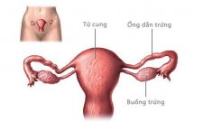 Bệnh viện Phụ sản Trung ương giới thiệu kỹ thuật mới “Xử lý tắc vòi tử cung đoạn kẽ bằng nội soi”