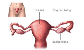 Thông tắc vòi tử cung bằng nội soi