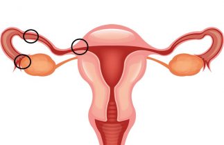 Tắc vòi trứng ở cả 2 bên có thể xuất hiện ở bất kì vị trí nào