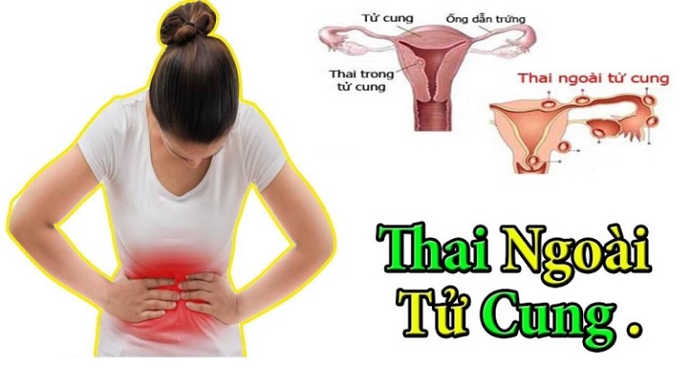 Tình trạng chửa ngoài dạ con nguy hiểm đến tính mạng người mẹ