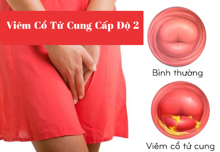 Viêm cổ tử cung cấp độ 2 có đáng lo ngại không?