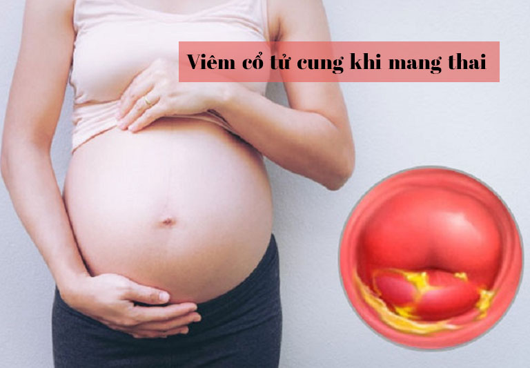 Viêm cổ tử cung khi mang thai nguy hiểm như thế nào và cách xử trí.