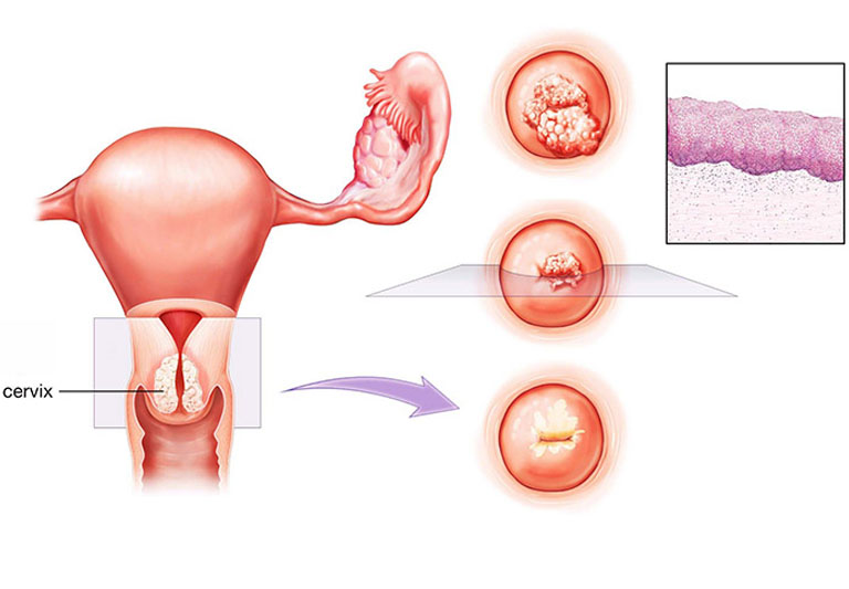 Biểu hiện thường gặp của cổ tử cung bị viêm là khí hư bất thường và ngứa ngáy vùng kín.