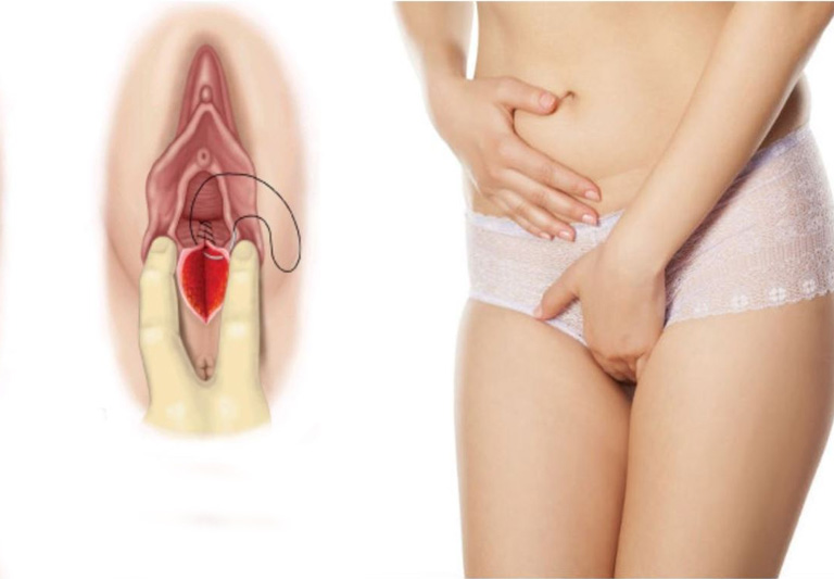 Vết thương ở tầng sinh môn sau sinh không được quan tâm vệ sinh cũng dễ gây ra bệnh viêm cổ tử cung.