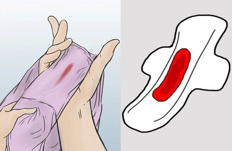 Bệnh nhân dễ bị xuất huyết âm đạo sau khi quan hệ tình dục do viêm cổ tử cung tái tạo.