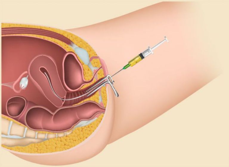 Nhiều người phân vân buồng trứng đa nang nên làm IUI hay IVF