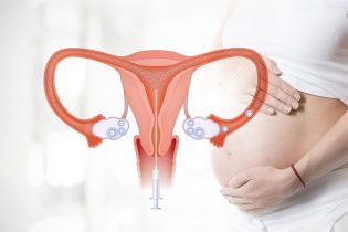 Buồng trứng đa nang nên làm IUI hay IVF - Phương pháp điều trị nào thích hợp?