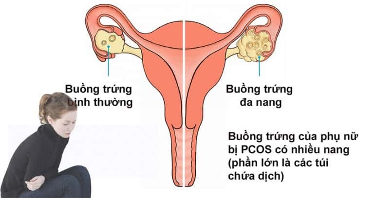 Đa nang buồng trứng ở tuổi dậy thì không hiếm gặp