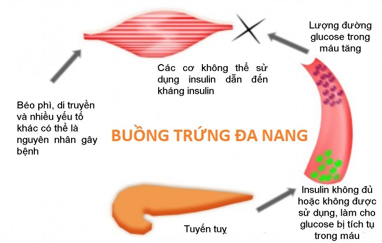 Những nguyên nhân có thể dẫn tới đa nang ở phụ nữ